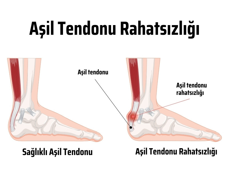 aşil tendonu yaralanması tedavisi