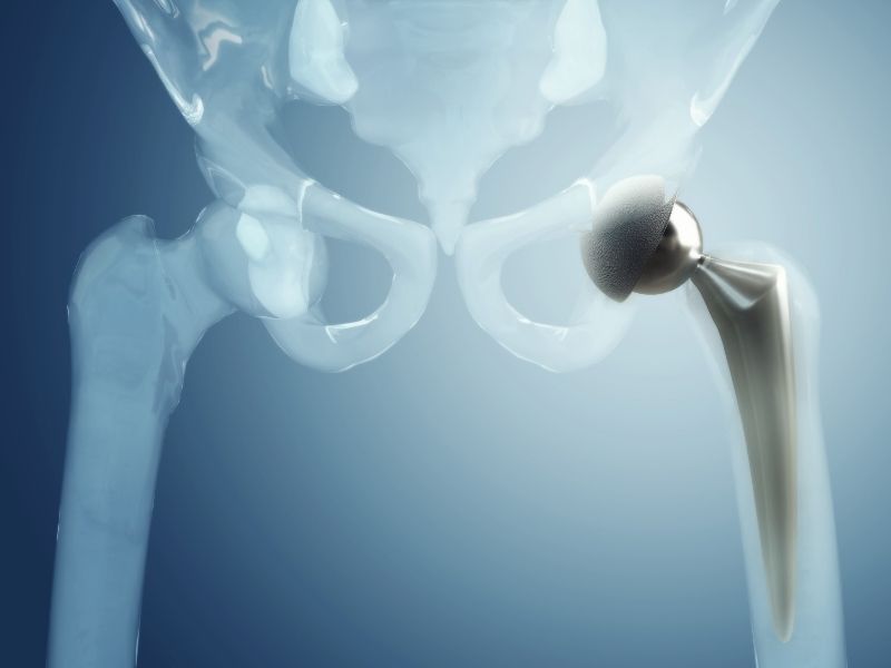 total kalça protezi