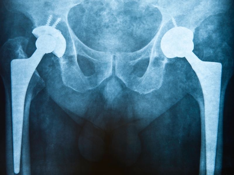 kalça protezi revizyon ameliyatı