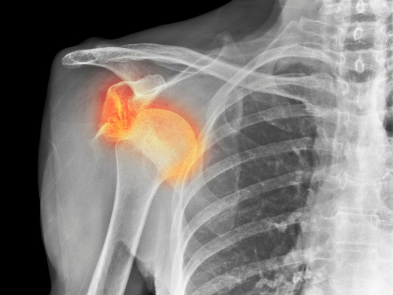 omuz çıkığı tedavisi