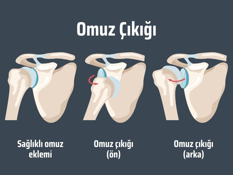 omuz çıkığı tipleri