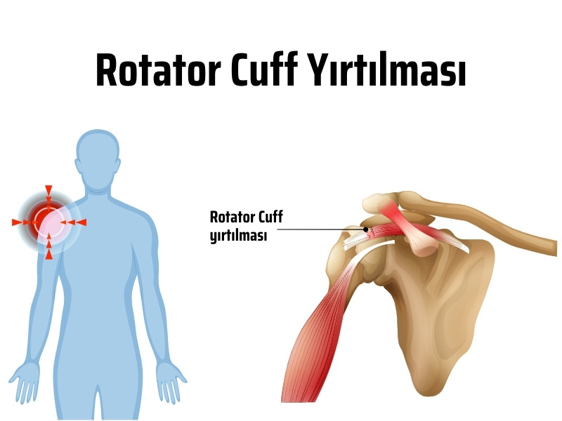 rotator cuff yırtılması nedir