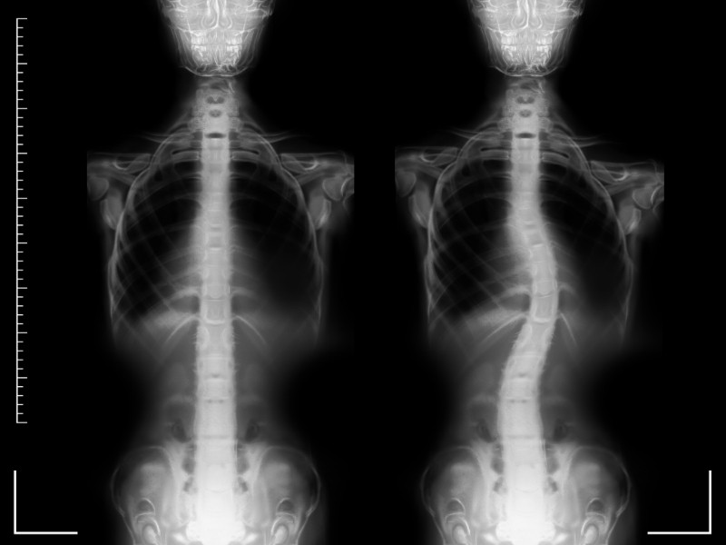 skolyoz hastalığı