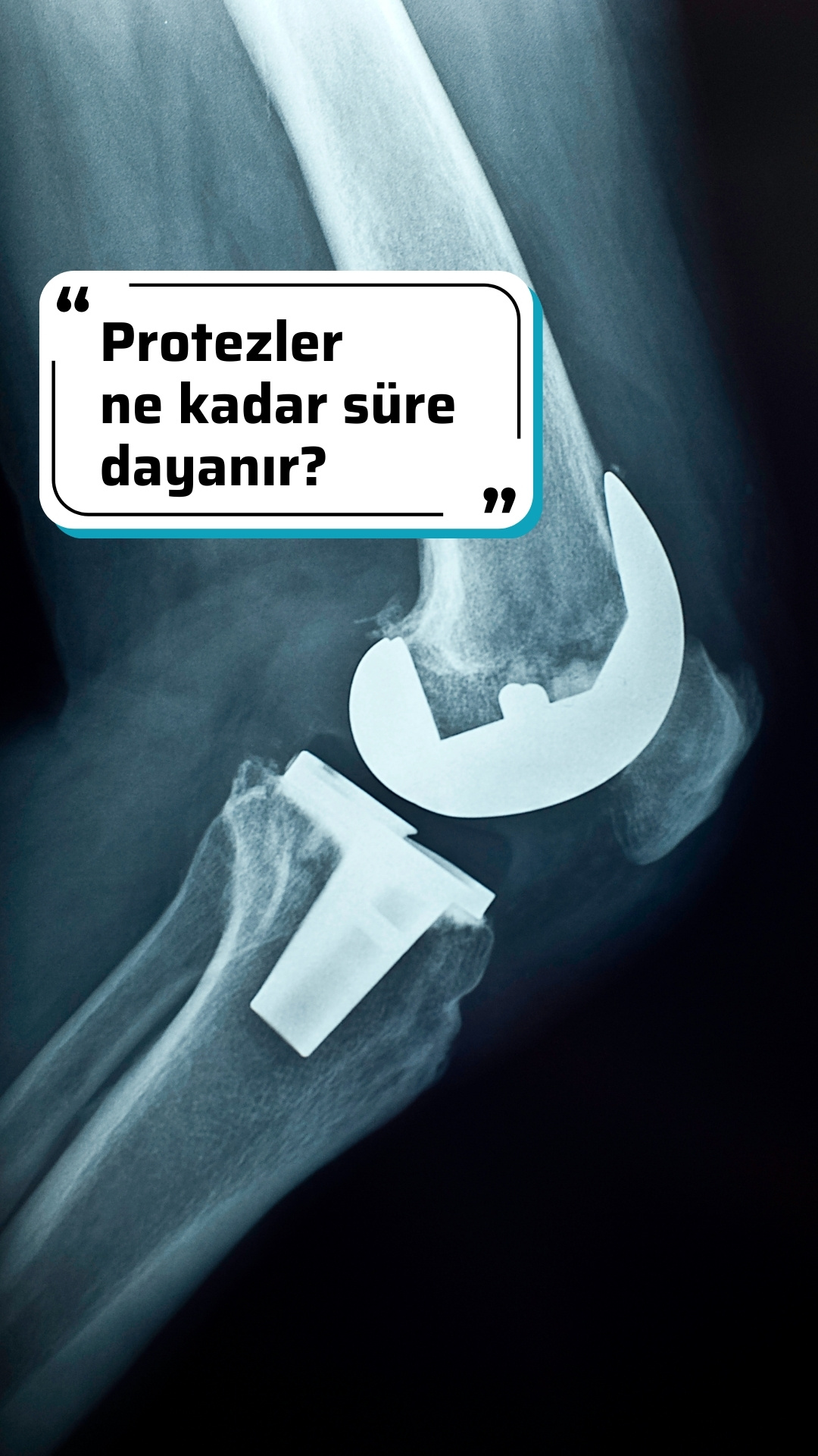 Ortopedi protezleri ne kadar dayanır?